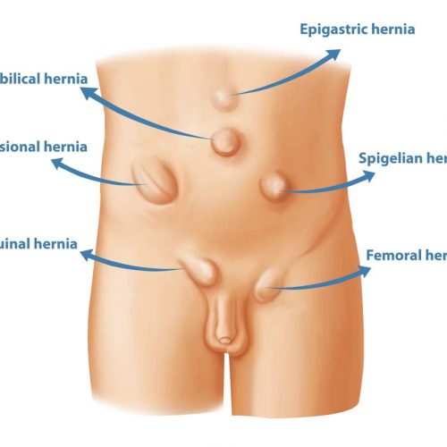 BRON-other-types-pf-hernia-perth-2